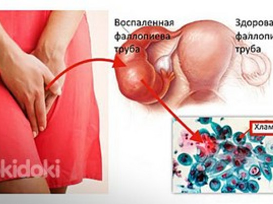 Экспресс-тест на хламидиоз
