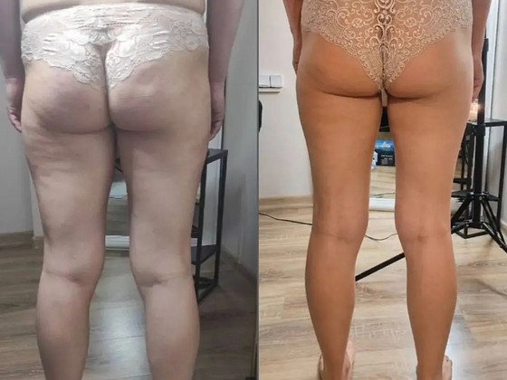 Антицеллюлитный массаж